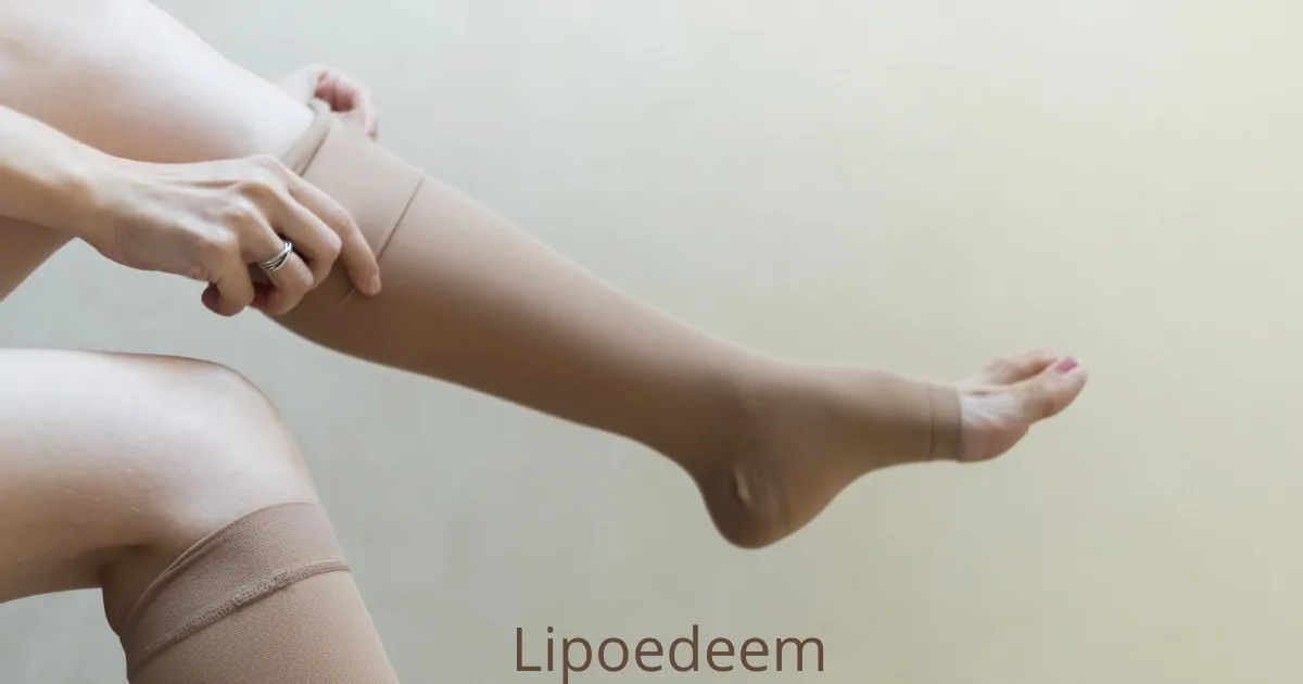 Lipoedeem symptomen herkennen: 7 signalen die artsen vaak missen