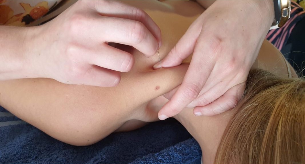 Dry Needling: Effectieve Behandeling voor Hardnekkige Spierklachten