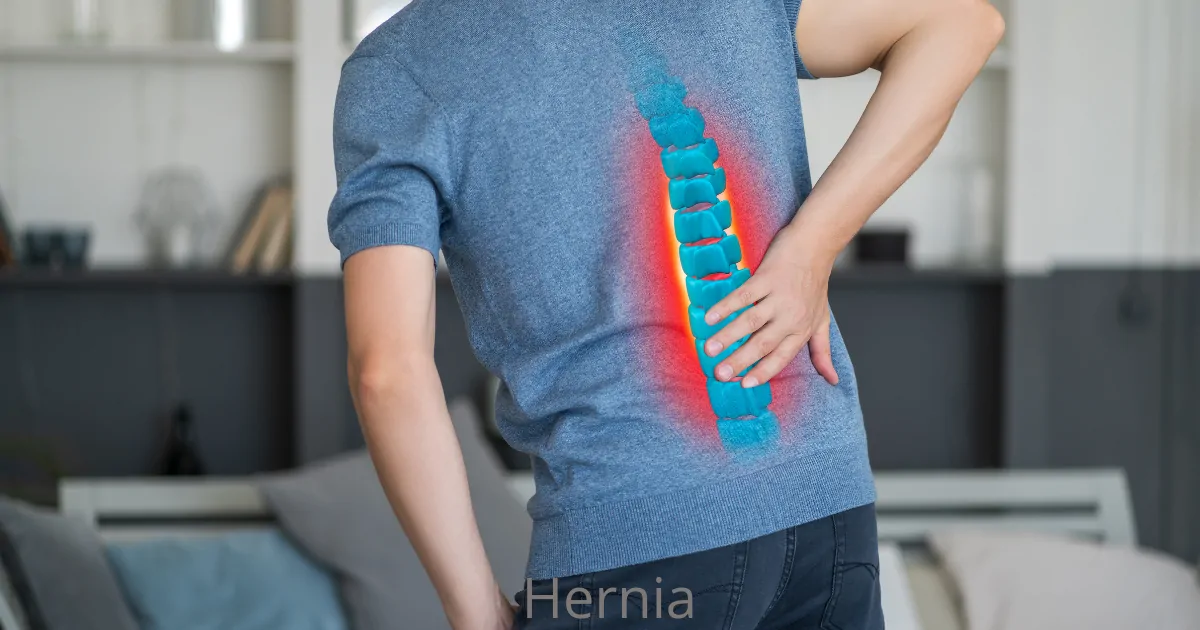 Hernia: Wanneer Helpt Kinesitherapie en Wanneer Niet?